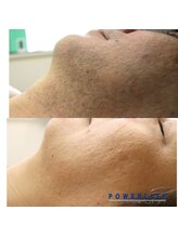 アモリアージュ(Amolliage)/パワー美肌脱毛・ひげ