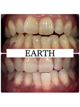 アース(EARTH)/【ビフォーアフター】美白