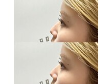 アーラ(ala)/上下ラッシュリフト