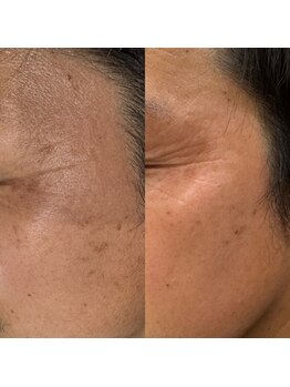 アンベリー ひびきの(embellie)/シミケア