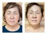 ★イチ押し小顔ケア【二重あご・エラ張り】フェイスライン集中9000→7000円