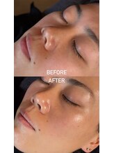 アンテグラール/日本初採用エクソソーム施術