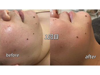 メイ 葛西(Mei)/小顔とリフトアップが叶う♪