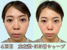 ナチュラルパーフェクトフェイス 新宿/フェイスラインのお肉／新宿小顔