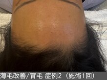 オアシスラグーン(OASIS LAGOON)/育毛促進（症例2施術1回）