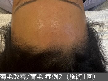 オアシスラグーン(OASIS LAGOON)/育毛促進(症例2施術1回)