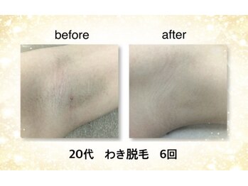 KMB 恵比寿店/わき脱毛 6回