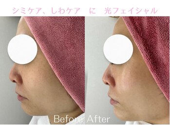 Cスキンケアクリニック 麻布店/光フェイシャルBeforeAfter