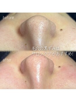 スピカ(Spica)/毛穴問題!これで解決!