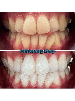 ホワイトニングショップ 京都駅前店/40分×10回Before/After