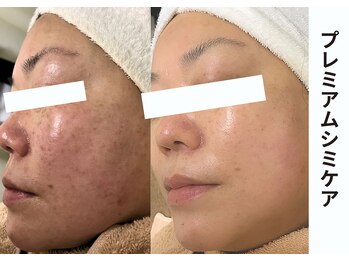 プレジール(plaisir)/シミケアコース