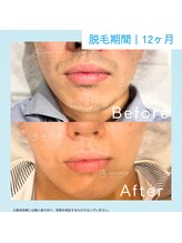 メンズクリア スマーク伊勢崎店/【メンズクリア】お客様の施術例