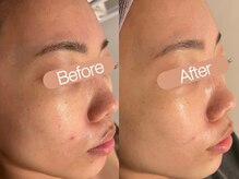 クレヴィア バイ サイバーエステ(CREBIA)/【OHL】ハーブピーリング