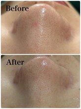 モテ 新宿店(Mote)/ハイドラ毛穴洗浄＋艶肌Wax 新宿