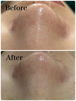 モテ 新宿店(Mote)/ハイドラ毛穴洗浄＋艶肌Wax 新宿