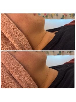 シュガー(Sugar...iyr)/レモンボトル