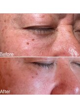 リュミエール デスポワール(Lumiere d'espoir)/原液100%臍帯幹細胞