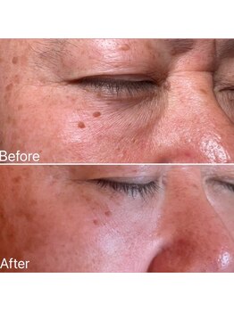 リュミエール デスポワール(Lumiere d'espoir)/原液100%臍帯幹細胞