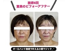50代女性コース卒業で見違える若見え♪瞼も軽やかパッチリ目へ！
