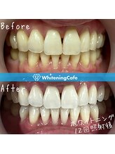 ホワイトニングカフェ 上田店/ホワイトニングビフォーアフター