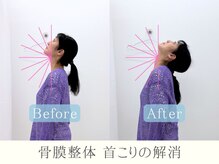 整体ヒラメント 藤沢院(Hilament)/ビフォーアフター：首こり