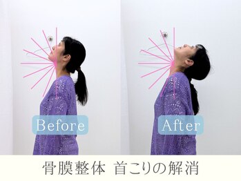 整体ヒラメント 藤沢院(Hilament)/ビフォーアフター：首こり