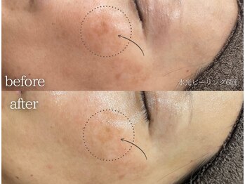 ミレット(Miretto)/【シミ・くすみ】水光ピーリング