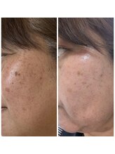 サロン アンネ(Anne)/剥離*ありハーブピーリング