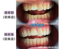 ネージュ(neige)/10代後半/女性