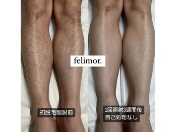 フェリモール(Felimor.)/メンズ光脱毛