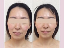 【お顔の歪み/非対称】20代女性×原因は身体の歪みから!?