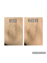 レイモード(Ray mode)/全身脱毛(VIOあり)