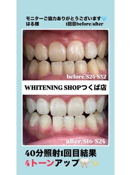 ホワイトニングショップ つくば店(WHITENING SHOP)/モニター照射1回目before/after
