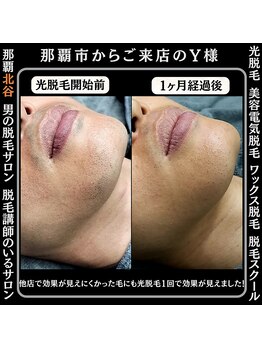 ディースタイル 北谷店(Dstyle)/北谷メンズ脱毛ヒゲBefore after