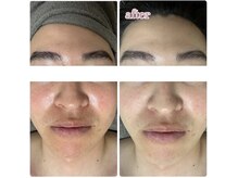 シミ・たるみケア専門店Labo荒尾大牟田【光フェイシャル/プラズマ/毛穴洗浄/韓国WAX】/毛穴洗浄/ハイドラフェイシャル