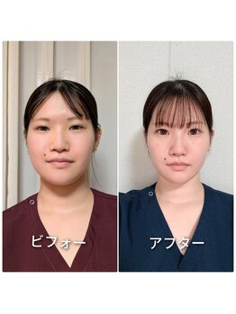 ハンドフィット(Handfit)/ビフォーアフター/翌日