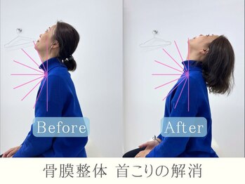 整体ヒラメント 藤沢院(Hilament)/ビフォーアフター：首こり