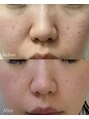 カレンジェビューティー(CarengeBeauty)&nbsp;私自身も毛穴で悩んでいたお肌が、ここまで変わりました！