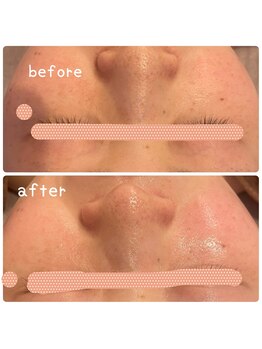 ヒメミ(Himemi)/BBL光エステでお肌生き生き!