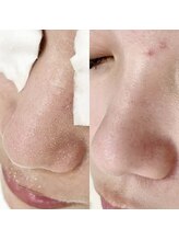 レディ(Lady)/毛穴洗浄