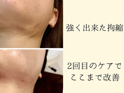 インディバ ミマリ(INDIBA ミマリ)の写真