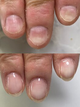 ハッチネイル(HACCI nail)/お客様BeforeAfter 10ヶ月