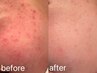 【短期集中肌質改善！3カ月で4回通える方！】ニキビ＆慢性的な赤み改善