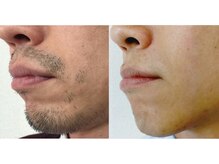 男前脱毛 菰野店/