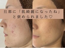アエオボンヌール(A.E.O BONHEUR)の雰囲気（体内環境の整え、お肌の修復力を高めて繰り返すニキビ卒業へ）