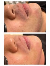 フリーダム(Freedom)/【脱毛前後写真】