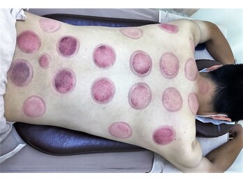 いきいき鍼灸整骨院/吸い玉施術後になります。