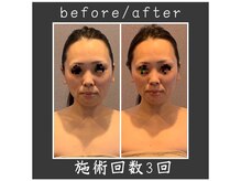 サロン ド ハーモニー美/コルギ♪小顔頬骨でっぱり改善等