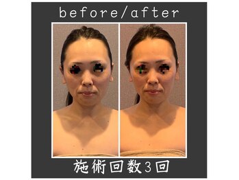 サロン ド ハーモニー美/コルギ♪小顔頬骨でっぱり改善等