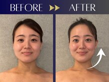 シンク(CINQ)/美容鍼灸90分はリピート率No.１